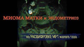 ЭНДОМЕТРИОЗ И МИОМА матки ПЕРИНЕВРАЛЬНЫЕ КИСТЫ на уровне S2 S3 на РАСШИФРОВКЕ МРТ малого таза