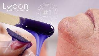 Goodbye Pesky Chin Hairs With LYCOJET Lavender Hot Wax  LYCON Cosmetics