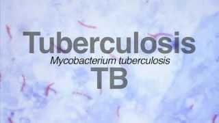 Screening of Latent TB Infection LTBI