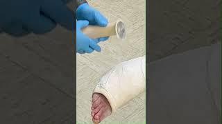Cast Removal