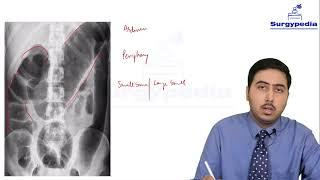 Intestinal Obstruction - Radiology