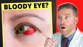 Broken Blood Vessel And Bloodshot Eye? - Subconjunctival Hemorrhage Causes Treatment