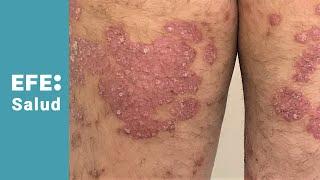 Freno a la psoriasis con innovación científica