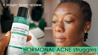 HORMONAL ACNE  K-beauty Skincare Some by Mi Magic Toner Review.