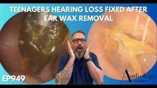 TEENAGERS HEARING LOSS FIXED AFTER EAR WAX REMOVAL - EP949