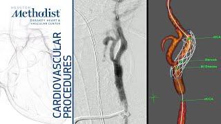Transcarotid Artery Revascularization A. Lumsden MD P. Osztrogonacz MD Y. Chauhan MD
