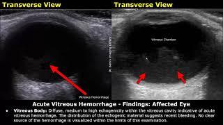 Eye Ultrasound Reporting  Cataract Retinal Detachments Vitreous Hemorrhage USG Case Reports