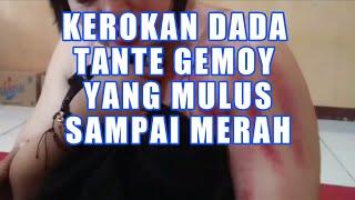 Kerokan merah dada wanita cantik sampai kesakitan