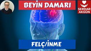 Beyin damarı tıkanıklığı Beyin damarı daralması Felç İnme Serdar Akgün