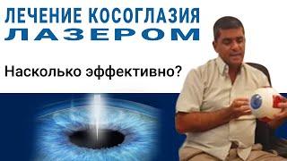 Лечение косоглазия лазером. Насколько эффективно?