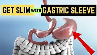  5 Top Weight Loss Surgeries Gastric Sleeve  Gastric Balloon  Benefits Risks and Results