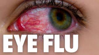 Eye flu hone par kya kare  Eye flu kaise hota hai  eye flu kaise thik kare  eye flu symptoms