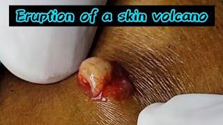 Relax your mind with popping of this creamy Cyst @Dr.AMAZINGSKIN