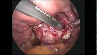 İkitərəfli endometriomaların laparoskopik üsulla çıxarılması