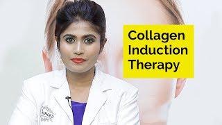 Collagen Induction Therapy  Skin Diaries