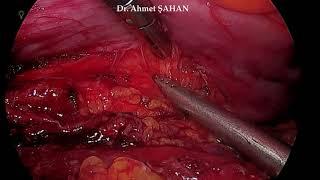 Laparoscopic Radical Nephrectomy with vena cava thrombectomy