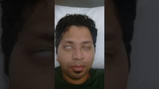 Guillain Barrie Syndrome Left Eye