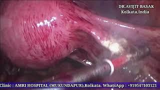 Ectopic Pregnancy  Laparoscopic Surgery by DR.AVIJIT BASSK