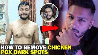 HOW To REMOVE CHICKEN POX DARK SPOTS From FACE  Zahid Akhtar