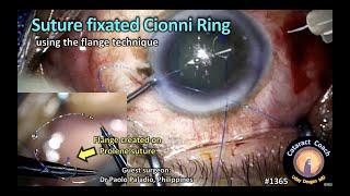 CataractCoach 1365 suture fixated Cionni ring CTR with flange technique