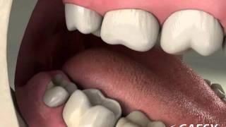 Oral Conditions Periconronitis