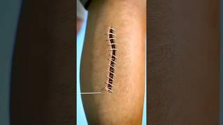 What You Need to Know About How Stitches Work 