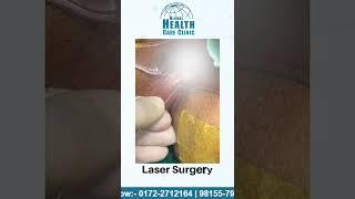 Anal Fistula Treatment with Laser