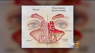 Doctor Tried And True Methods For Sinus Relief Are Still Best