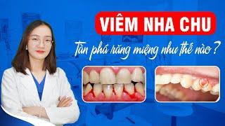 Viêm Nha Chu Tàn Phá Răng Miệng Như Thế Nào ?  Nam Bùi Vinalign