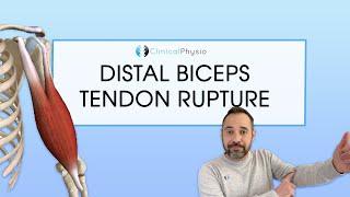 Distal Biceps Tendon Rupture  Expert Physio Review