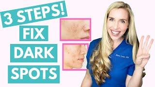 Fix Your Dark Spots in 3 Steps  Hyperpigmentation  Melasma  Skincare Made Simple