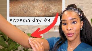 12 Life Changing Tips For Eczema From a Derm with Eczema
