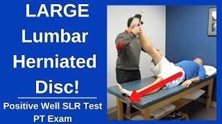 Positive Well Straight Leg Raise Test Large Herniated Disc