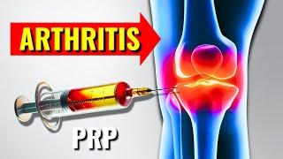 Do PRP Injections Work for Severe Knee Arthritis?