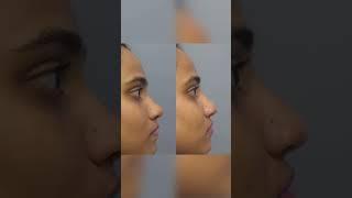 The Future of Nose Reshaping 5 Facts About Non-Surgical Rhinoplasty