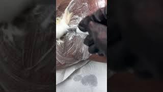 Skin Condition Hidradenitis Suppurativa. #skin #skincare #hs #wax #esthetician #viralvideo