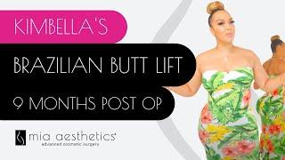 Kimbellas BBL - 9 Month Post Op - Brazilian Butt Lift Before & After By Dr. Mehio At Mia Aesthetics