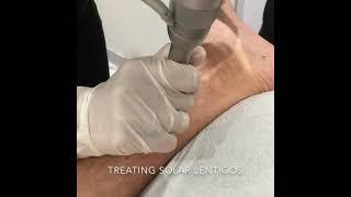 Solar Lentigo Treatment