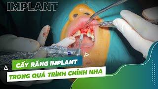 Cấy Implant răng cửa trải qua quá trình như thế nào?