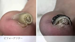 たった一回の巻き爪矯正で、ここまで！【本厚木・海老名】 Ingrown nail correction