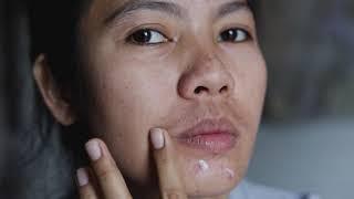 Acne Causes and Treatments