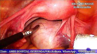 Total Laparoscopic Hysterectomy with BSO Dermoid cyst by Dr.Avijit Basak