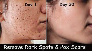 Remove Chickenpox Scars Marks on Face at Home - Dark Spots Hyperpigmentation & Large Open Pores