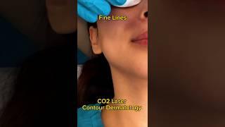 CO2 Laser Changed My Skin? #acne #acnescars #beauty