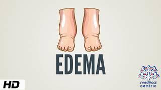 Edema Causes Signs and Symptoms Diagnosis and Treatment.