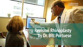 Revision Rhinoplasty Surgery  Seattle Facial Plastic Surgeon - Dr. William Portuese  ‍️