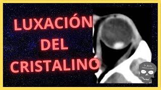 LUXACIÓN del CRISTALINO Así se ve en TOMOGRAFÍA