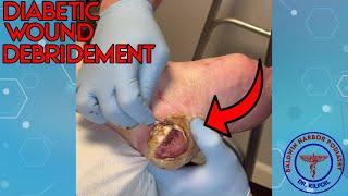 Diabetic Wound Debridement by Dr. Roger Kilfoil - Podiatry Explained