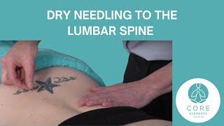 Dry Needling to the Lumbar Spine - #dryneedling for Lower Back pain