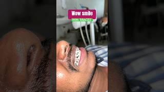 Wow smile in process with braces #bestdentistinhyderabad #braces #trending #invisalignhyderabad